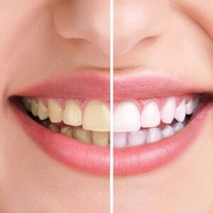 Teeth whitening in DHA lahore