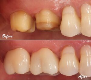 Dental Crown Dental Bridge